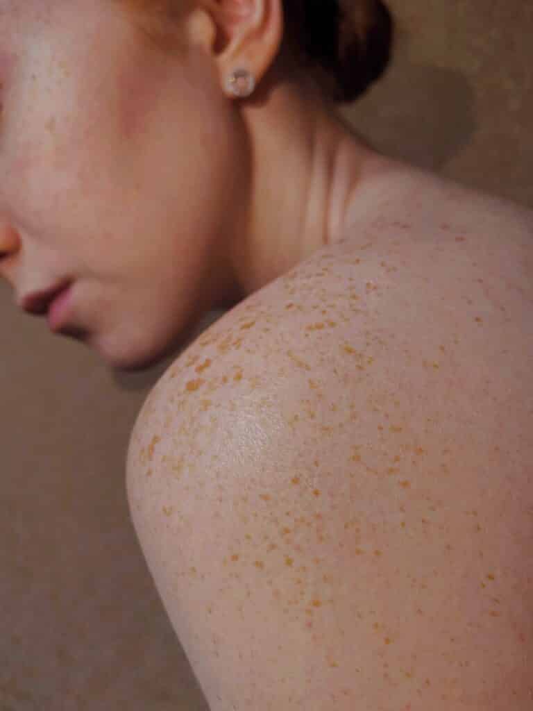 dermatologia en Sevilla y manchas en la piel